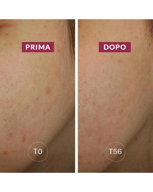 Siero Anti Macchie Azione Anti Ricomparsa